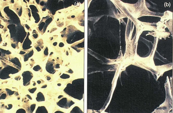 Normálna a osteoporotická štruktúra kosti